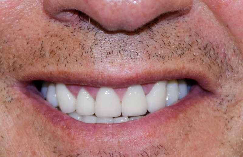 Fractura e desgaste de toda a dentição devido a Bruxismo. Reabilitado com Coroas Dentárias e Coroas Sobre Implantes.