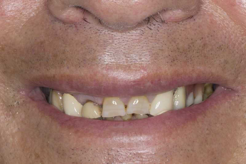 Fracture and wear of the entire dentition due to Bruxism. Treated with dental crowns and crowns on implants